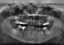tooth-1462410_1280-1280x630
